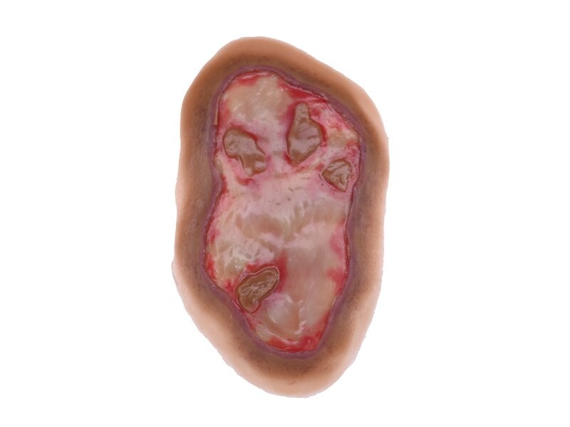 Chemical Burn - Laerdal Medium