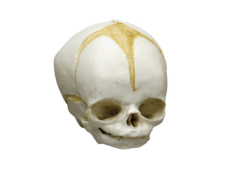 Fetal skull 32 weeks