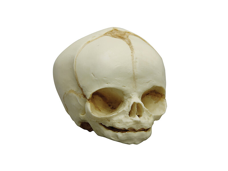 Fetal skull 31 weeks