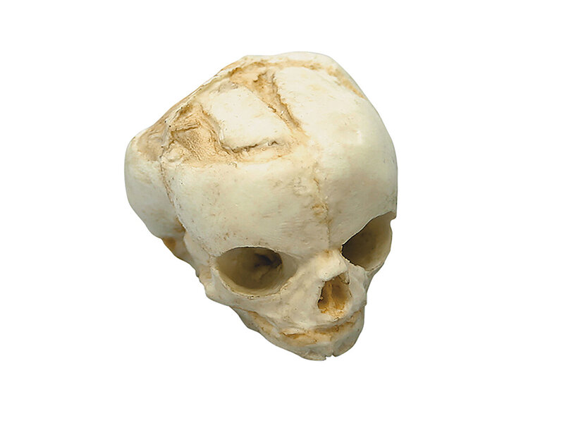 Fetal skull 17 weeks