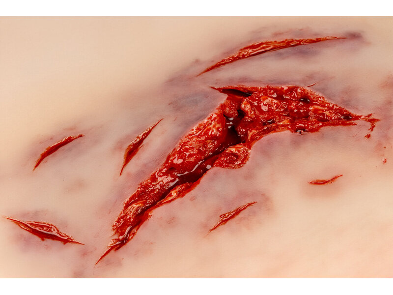 Laceration with Bleeding