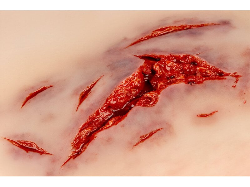 Laceration with Bleeding
