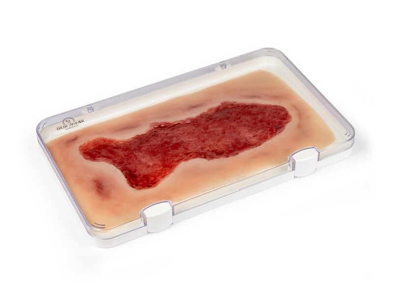 Venous Leg Ulcer Large