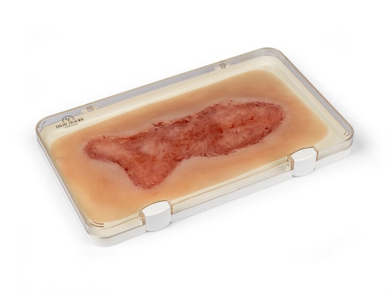 Venous Leg Ulcer Large