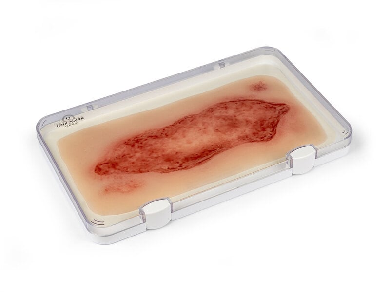 Arterial Leg Ulcer Large