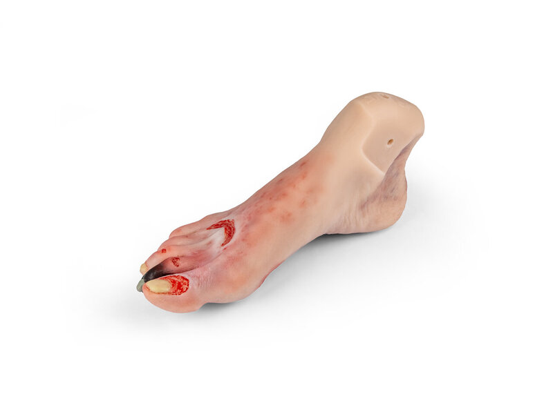 N. Anne Foot Syndrome,