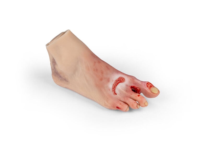 Severe Foot Syndrome,
