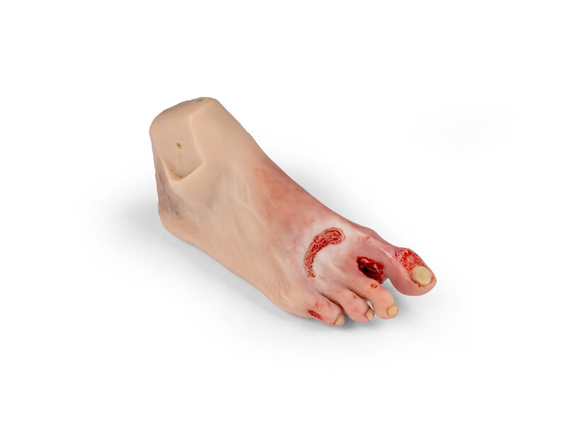 N. Anne Severe Foot