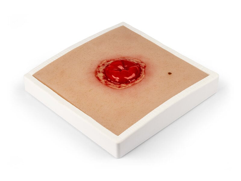 Inflamed Colostomy