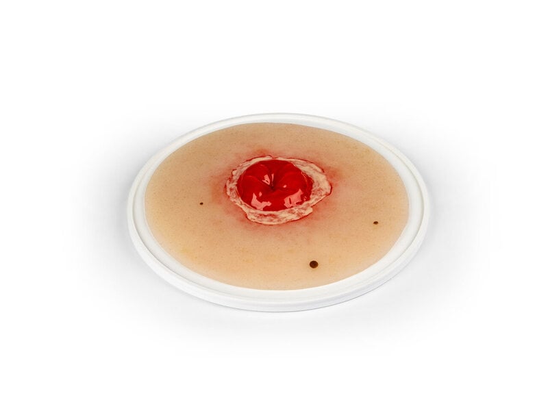 Colostomy Inflamed