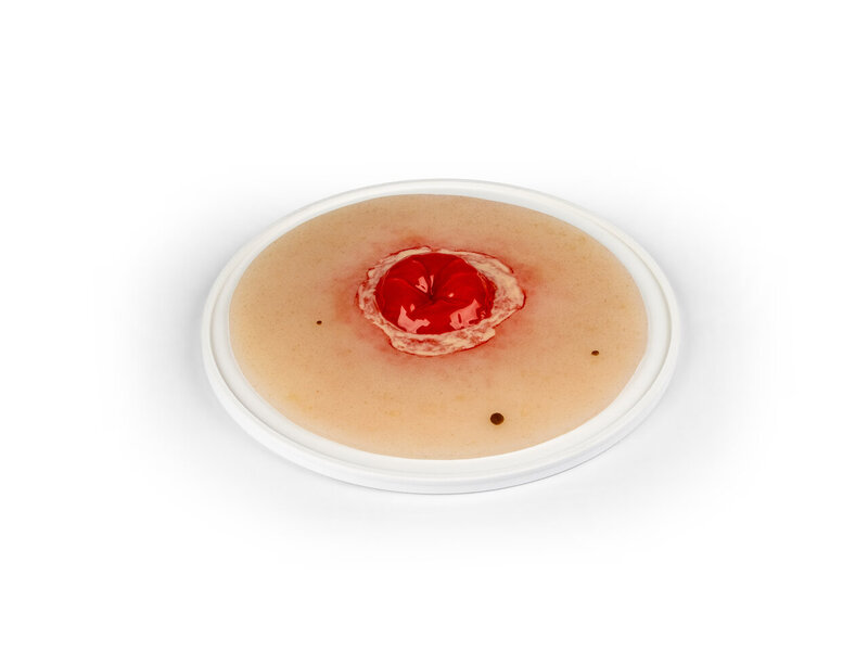 Colostomy Inflamed