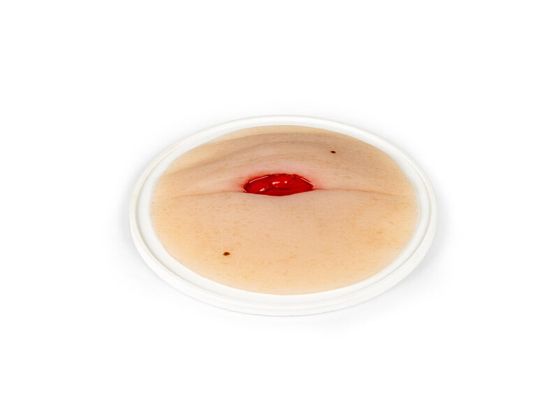 Colostomy Abdominal Fold
