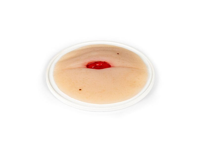 Colostomy Abdominal Fold