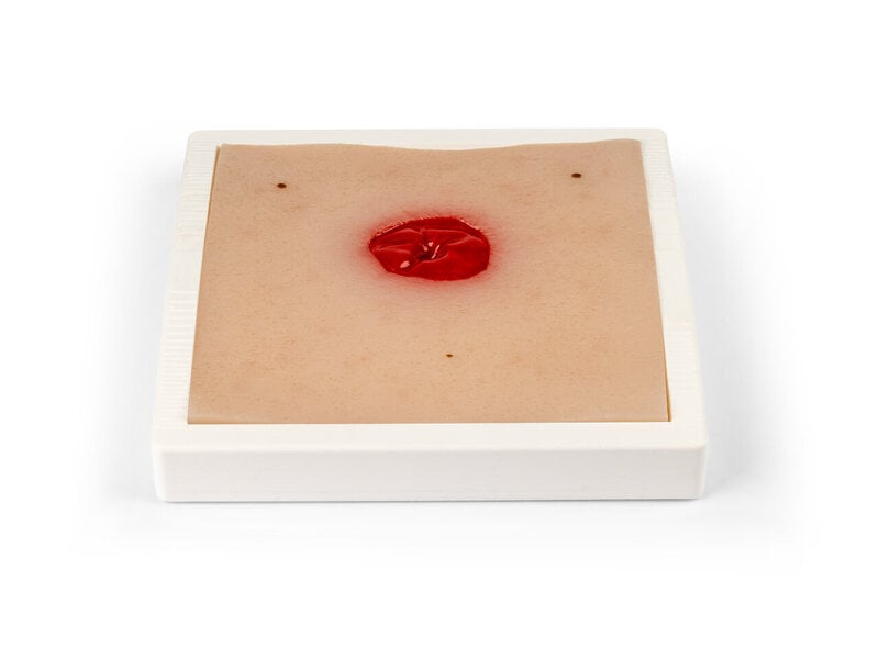 Under Skin Colostomy
