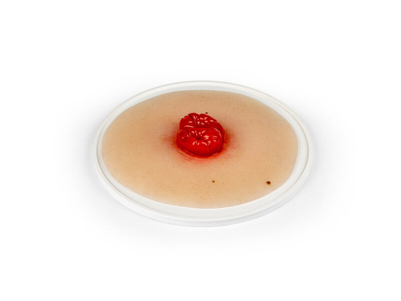 Colostomy Double Barrel