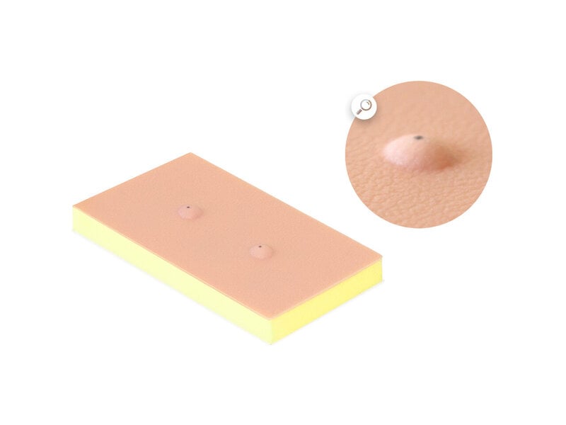 Pad cisti sebacea