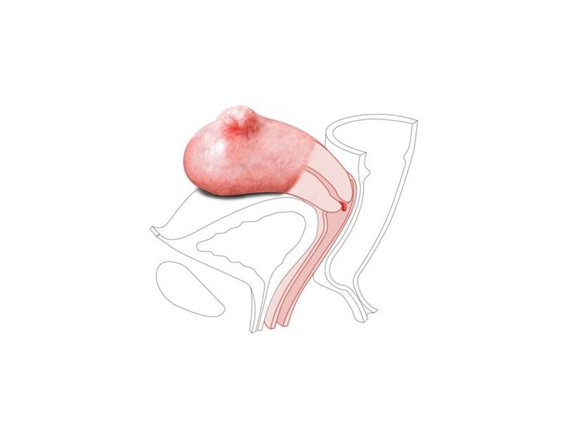CFPT Mod 3:Small Fibroid Nulliparous Polyp Cervix